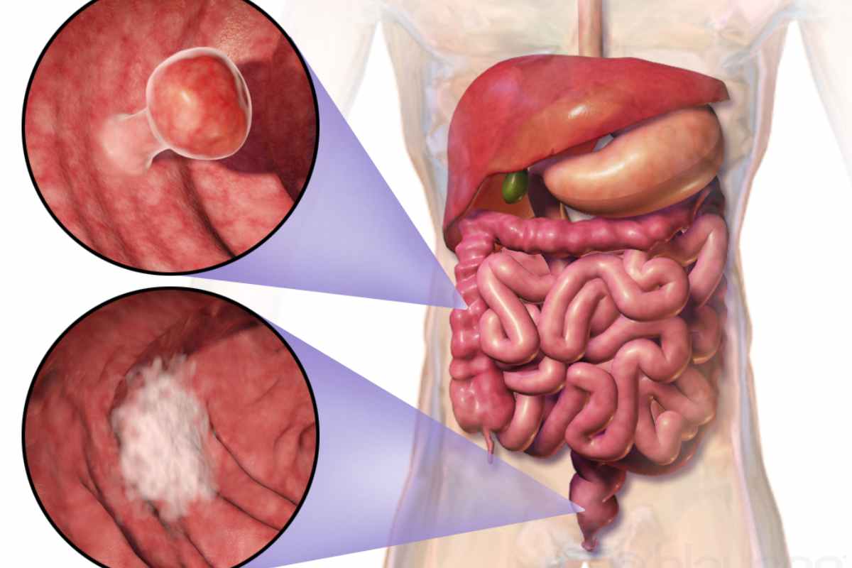 Il rischio del tumore al colon