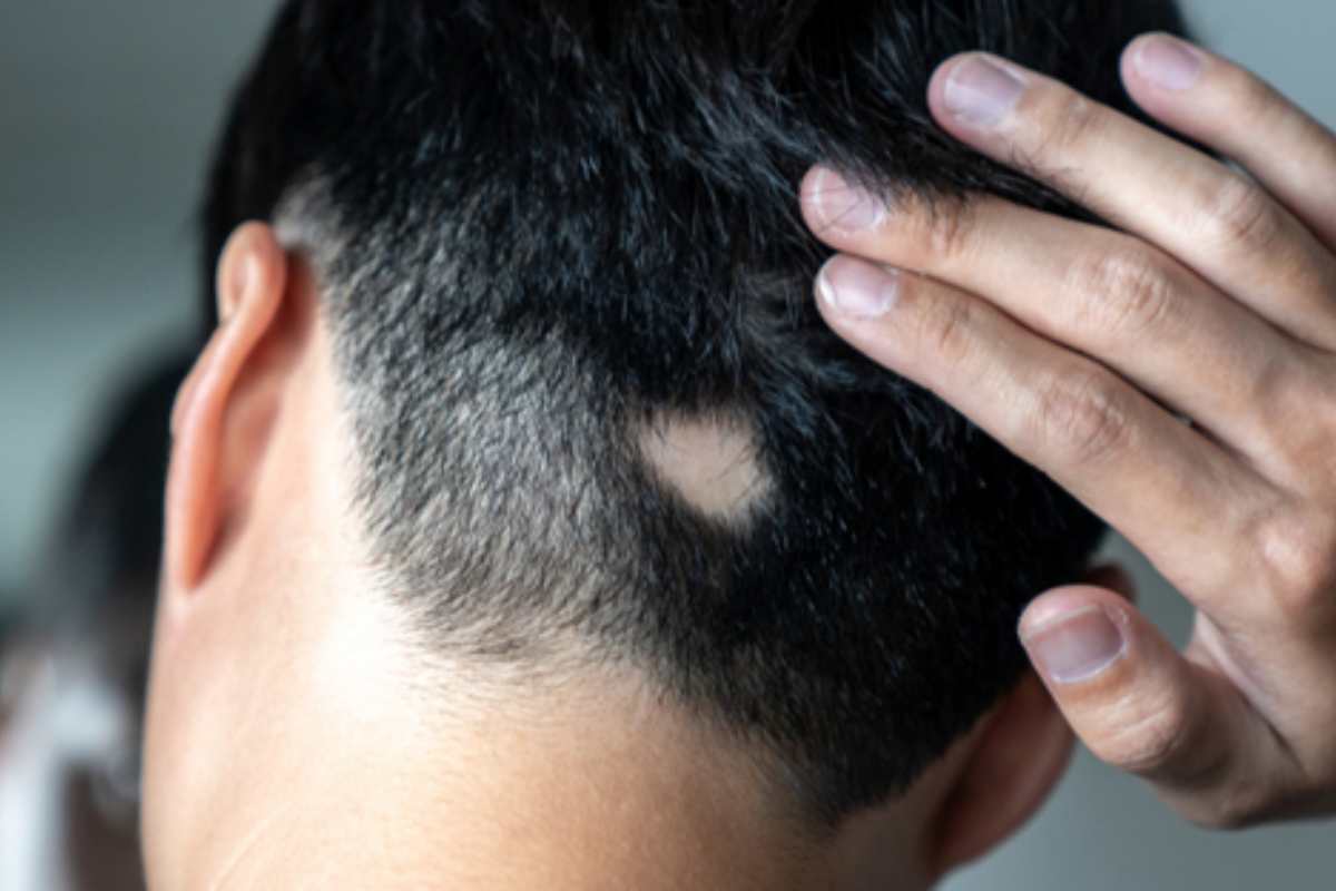 alopecia farmaci consigli