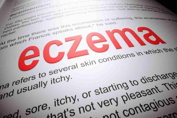 Eczema rimedio camomilla - Parolibero.it