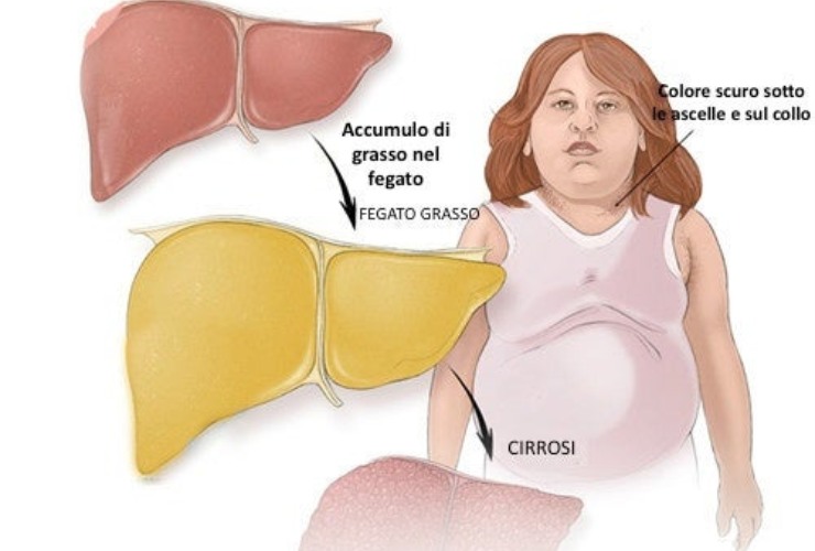 Tiroide e fegato grasso